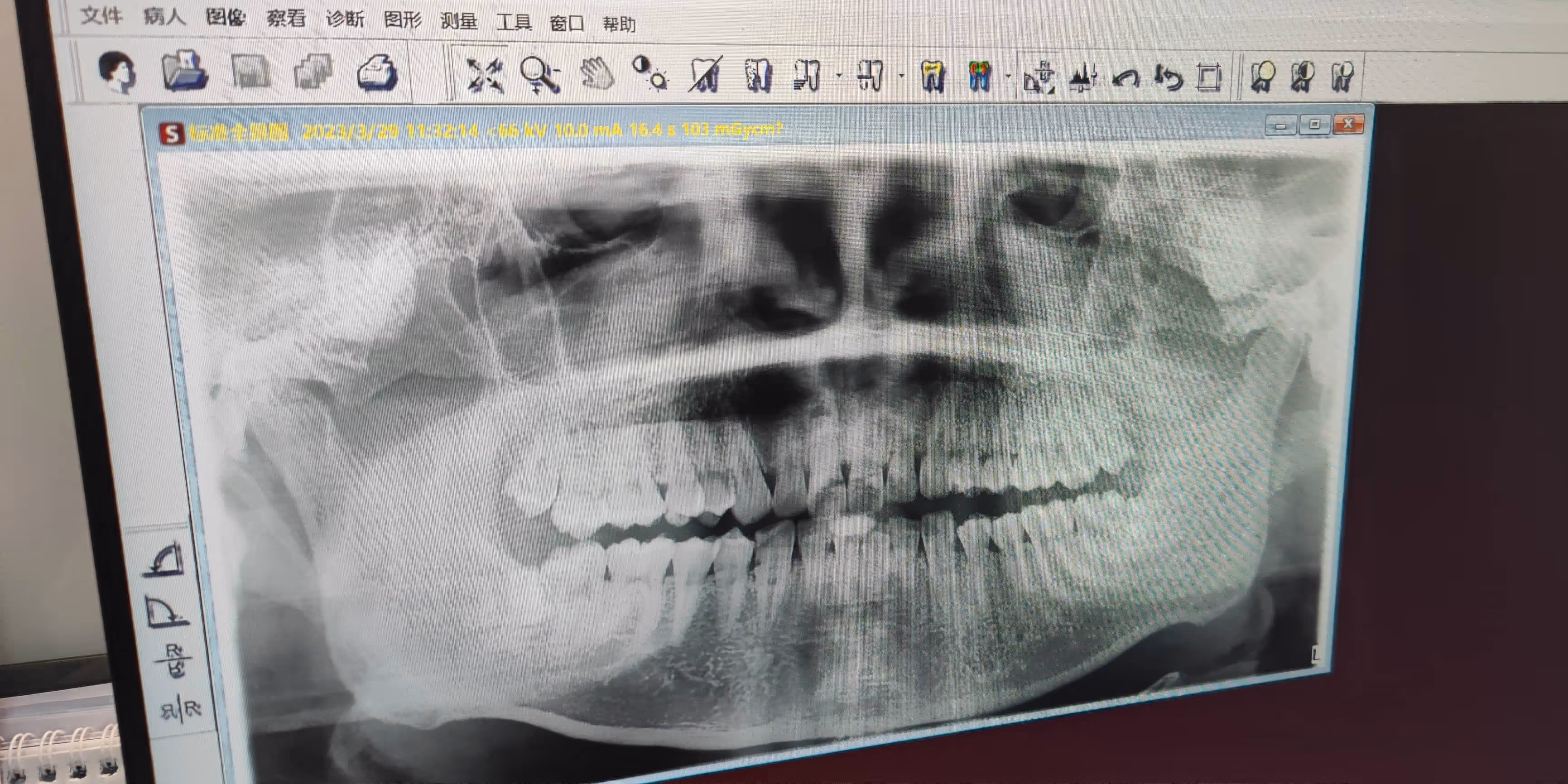 X 光检查 X 光检查